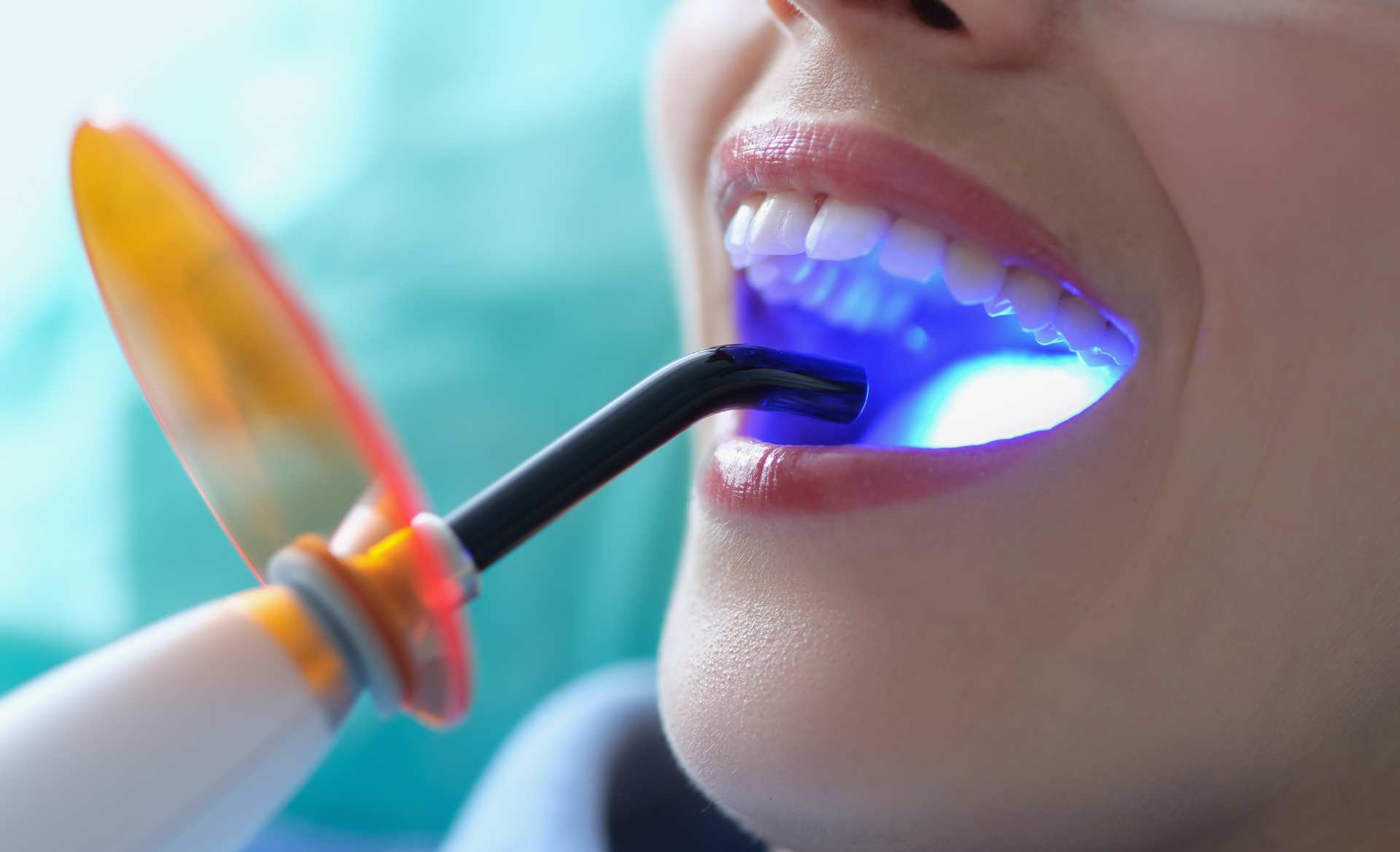 Teeth Whitening London