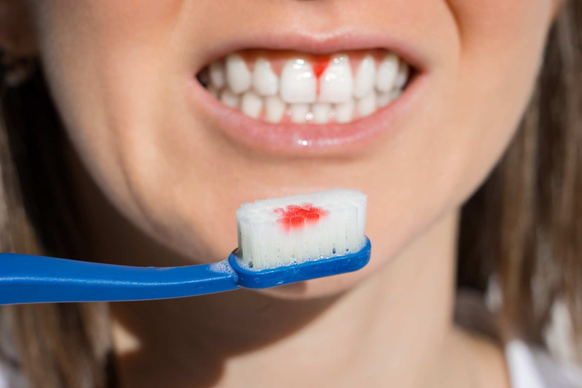 01 A young woman with bleeding gums due to the effect of toothbrushing