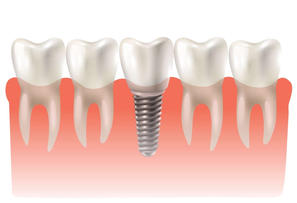 03 A dental crown prosthesis in esthetic and functional harmony with natural teeth