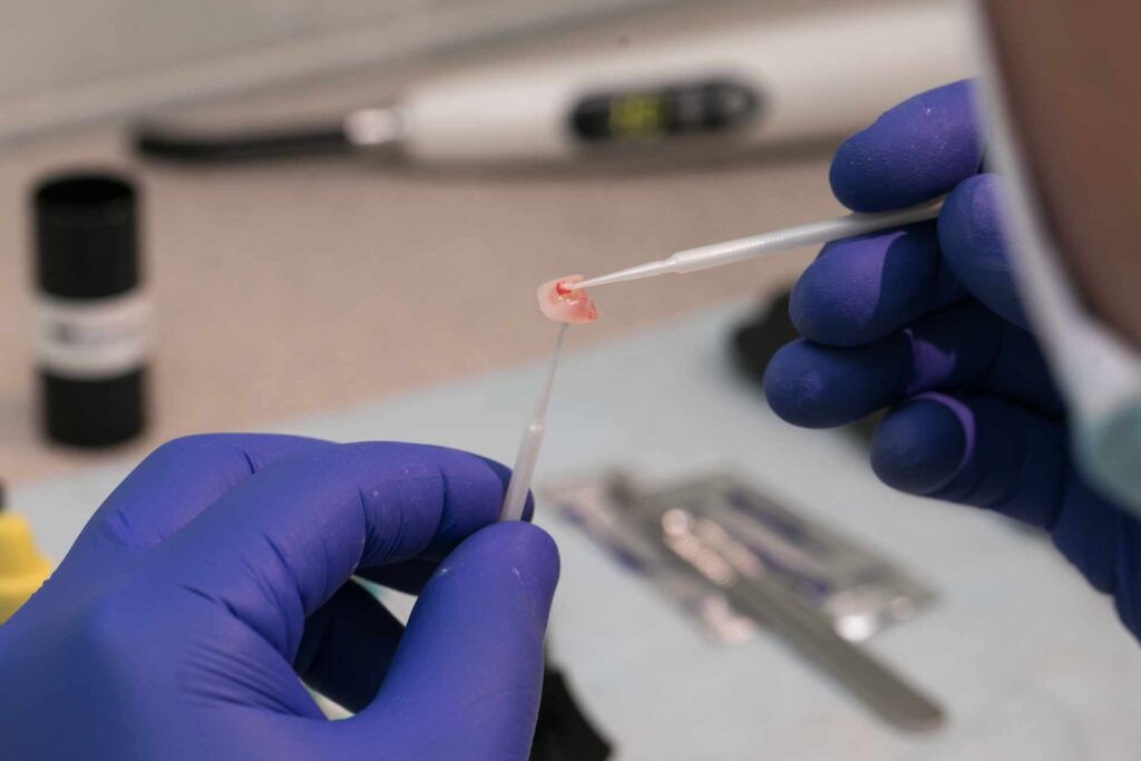 06 Dentist applying adhesive to a porcelain dental veneer before placing it on the tooth