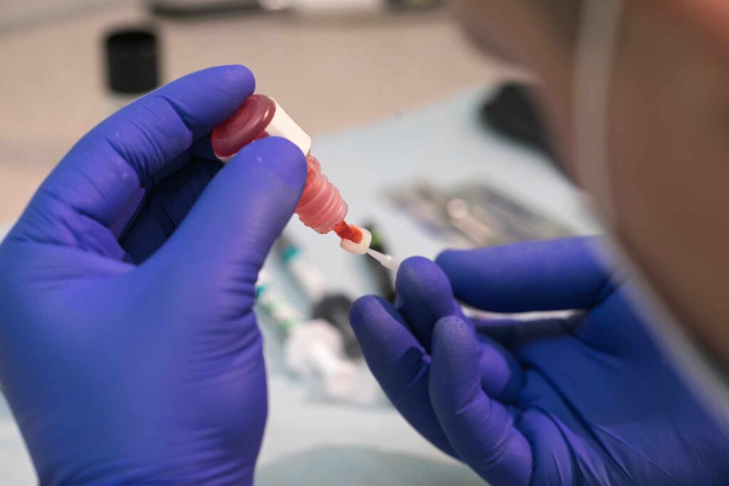 A dentist applying special adhesive to a dental veneer before bonding it to the patient's teeth.