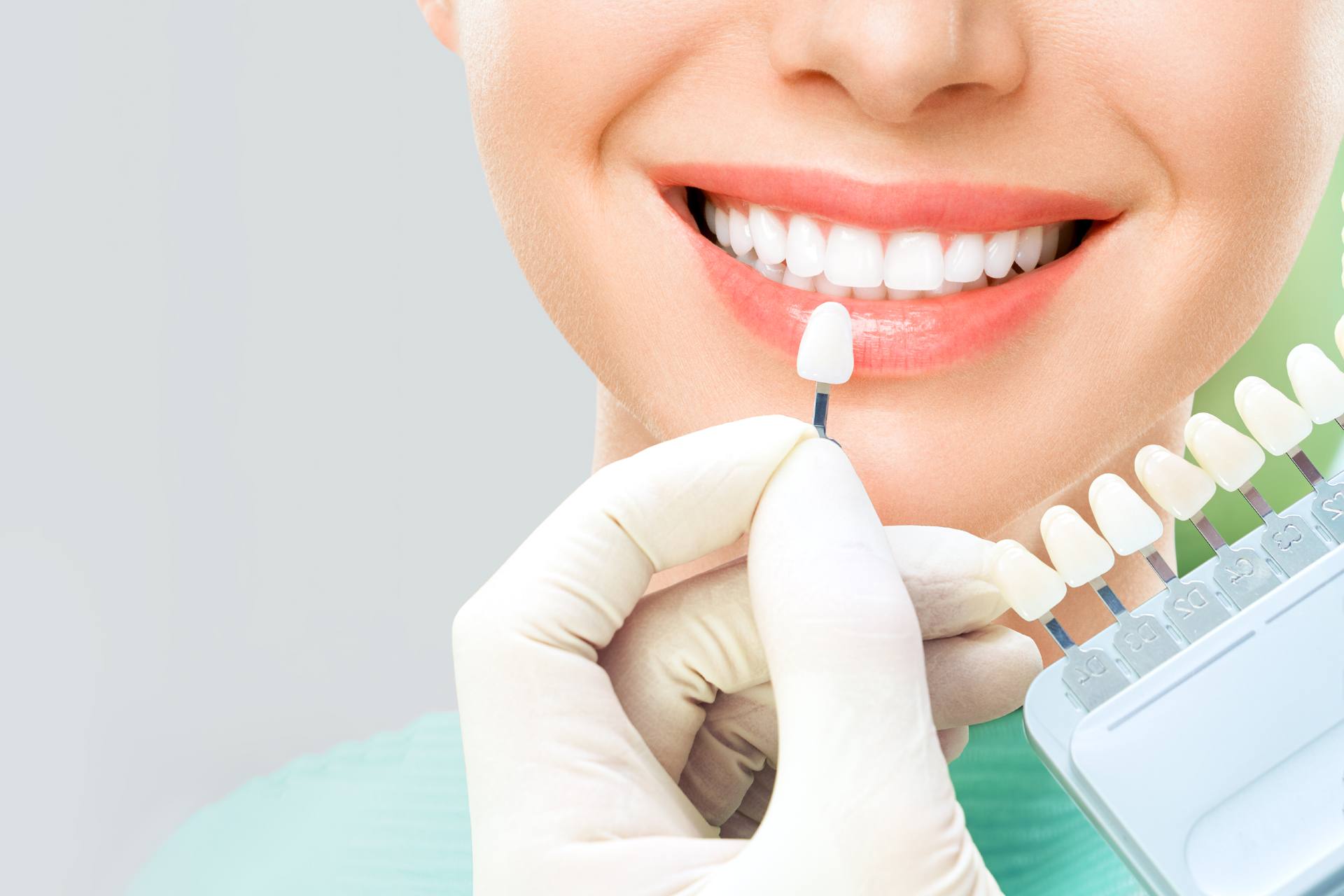 01 Dentist choosing the color of veneers for your patient using the porcelain veneer color chart_Porcelain veneers vs. bonding