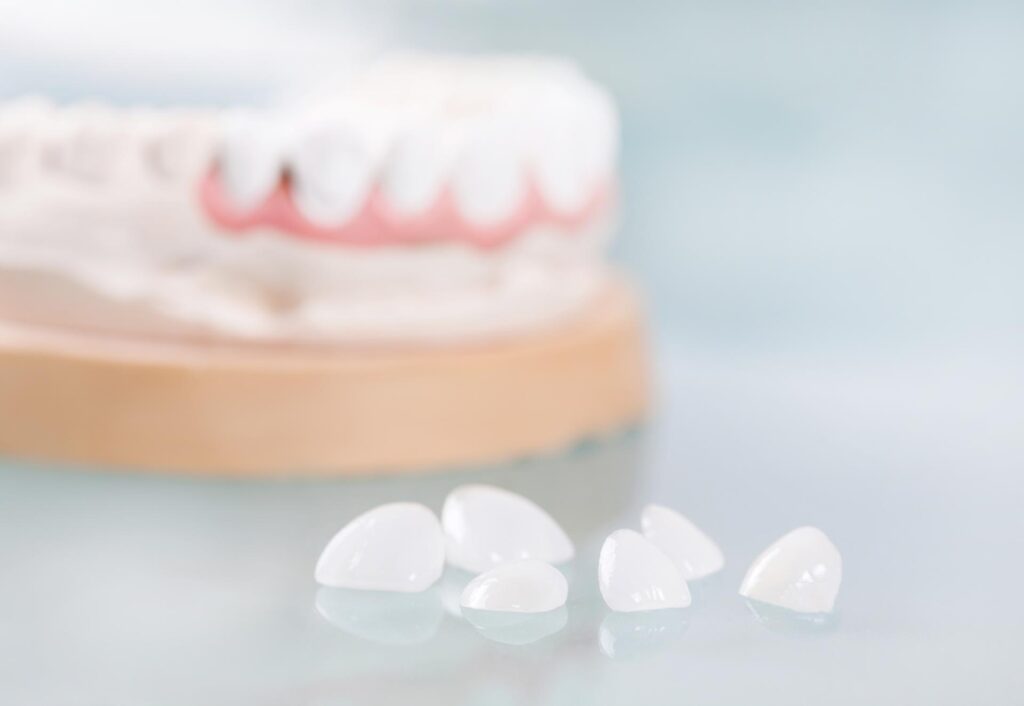 03 Various porcelain veneers on a glass table