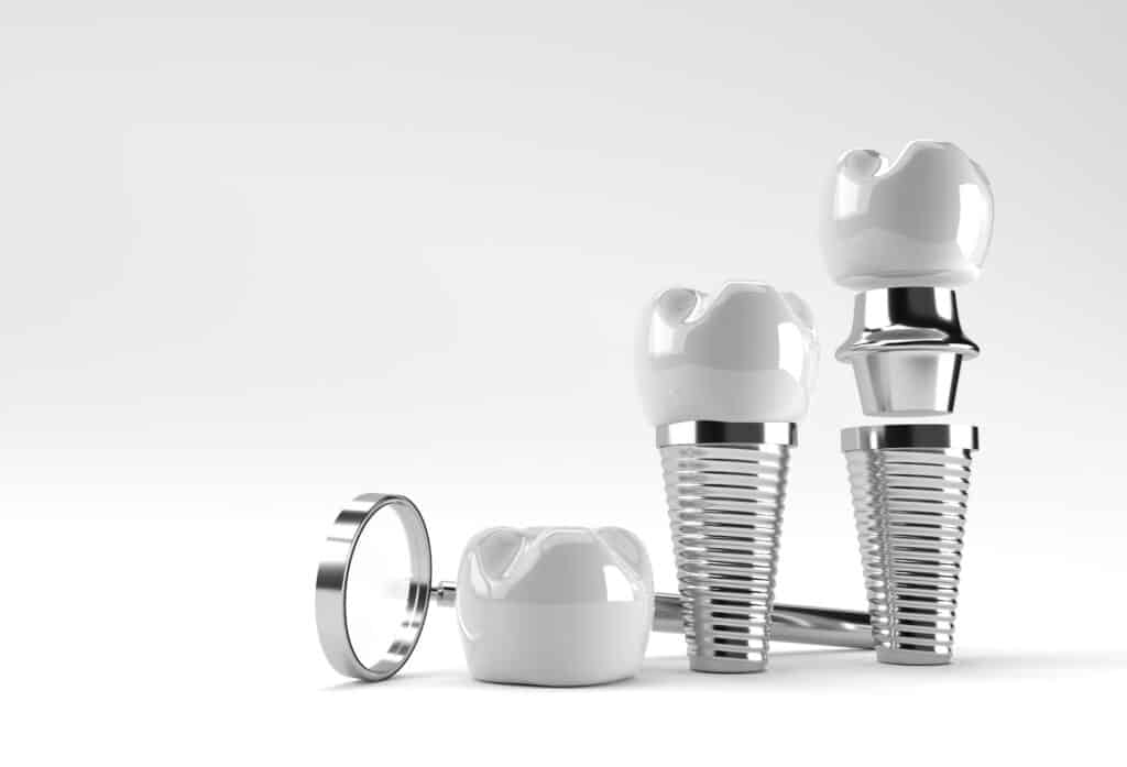 04 3D Illustration of dental implant surgery concept_What is the risk of dental implants_Dental implants pros and cons