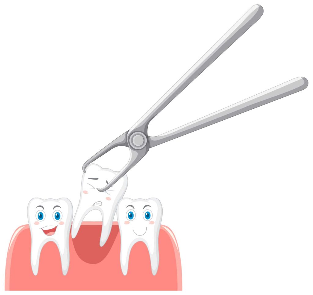 07 Cartoon drawing illustrating the extraction of a tooth_Dental implants procedure, dental implants in Miami