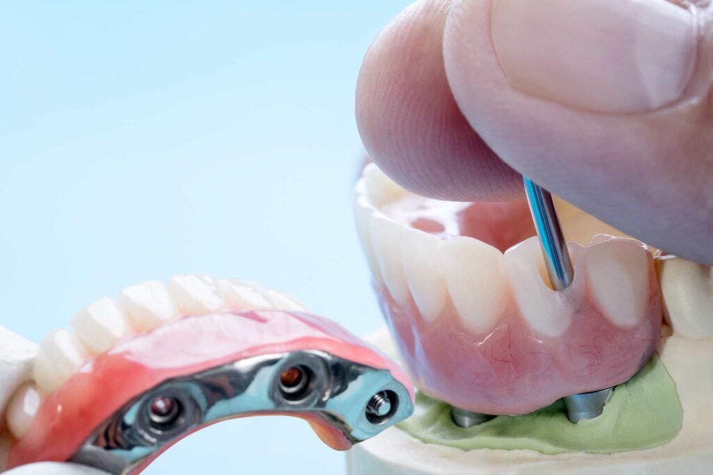 09 Complete dental prosthesis placed over several dental implants_Types of dental implants