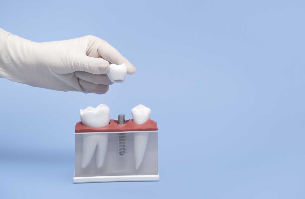 11 Gloved hand placing the dental crown on an implant on a denture mock-up_Dental implant procedure, dental implants in Miam