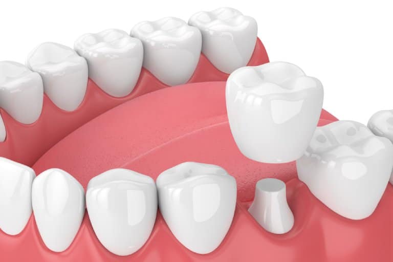 Dental Crowns​