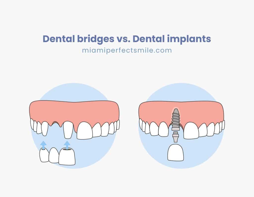 Dental bridges vs. Dental implants (with 2 comparative tables)