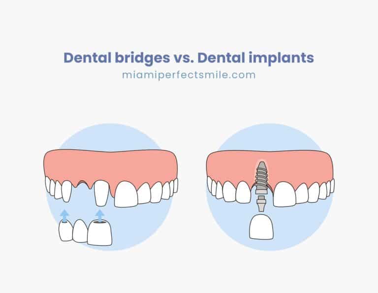 01 Dental bridges vs Dental implants Miami Perfect Smile dental bridges vs dental implants