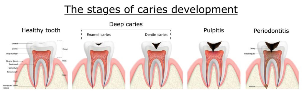 The stages of caries development_Composite dental filling service in Miami Perfect Smile