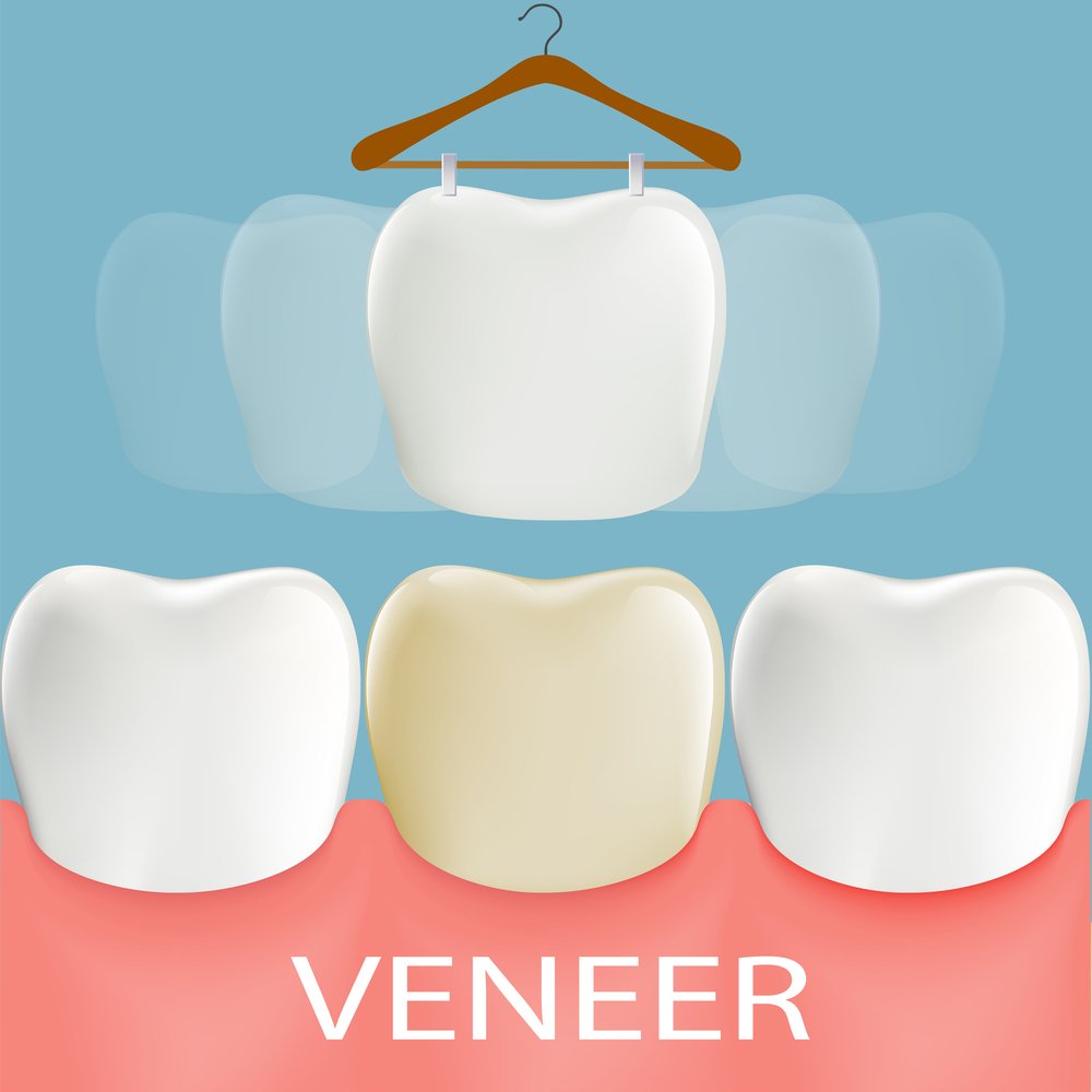 Average Cost of Veneers in Mexico City