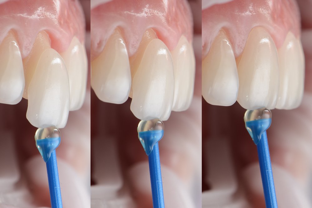 Choosing the Right Clinic for Your Veneers