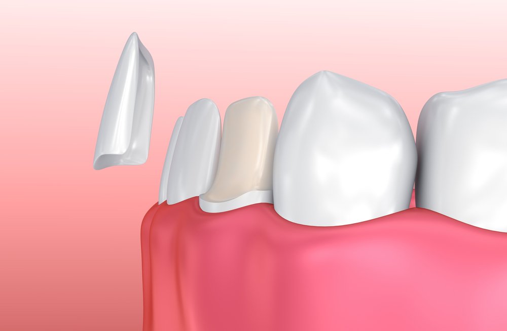 Dental Insurance and Veneer Coverage