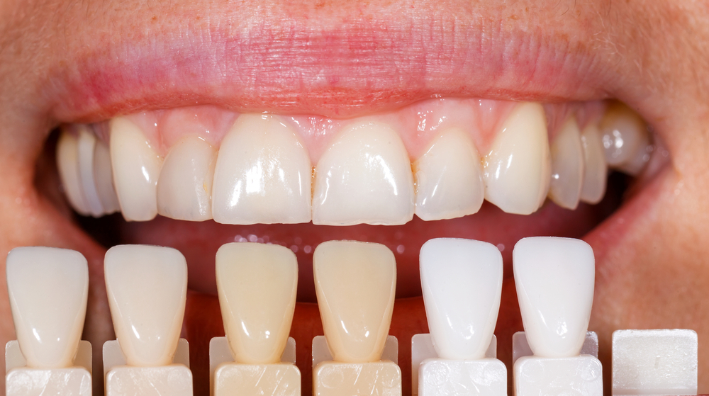 Factors Affecting Veneer Pricing