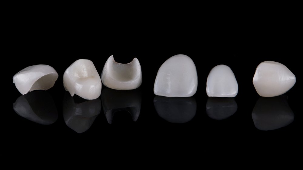 Factors Affecting Veneer Replacement Cost