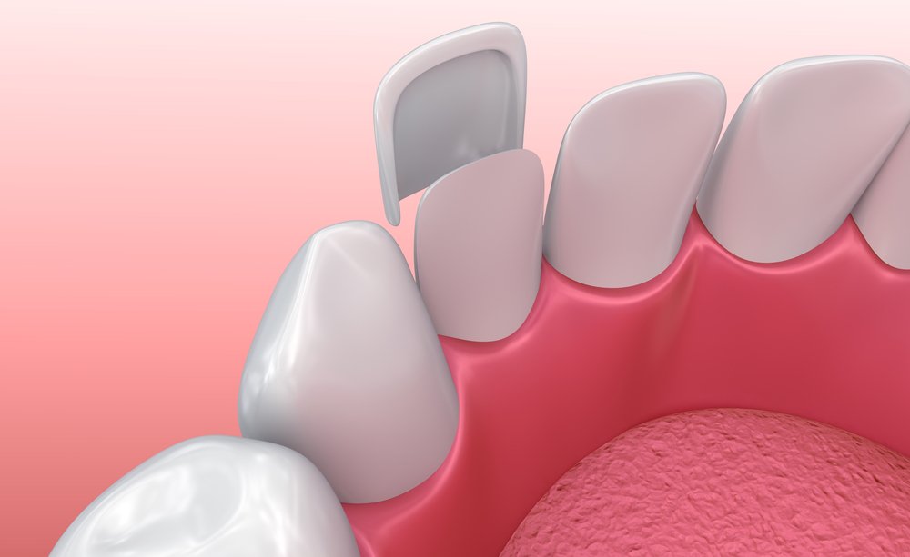 How much are full mouth veneers in US