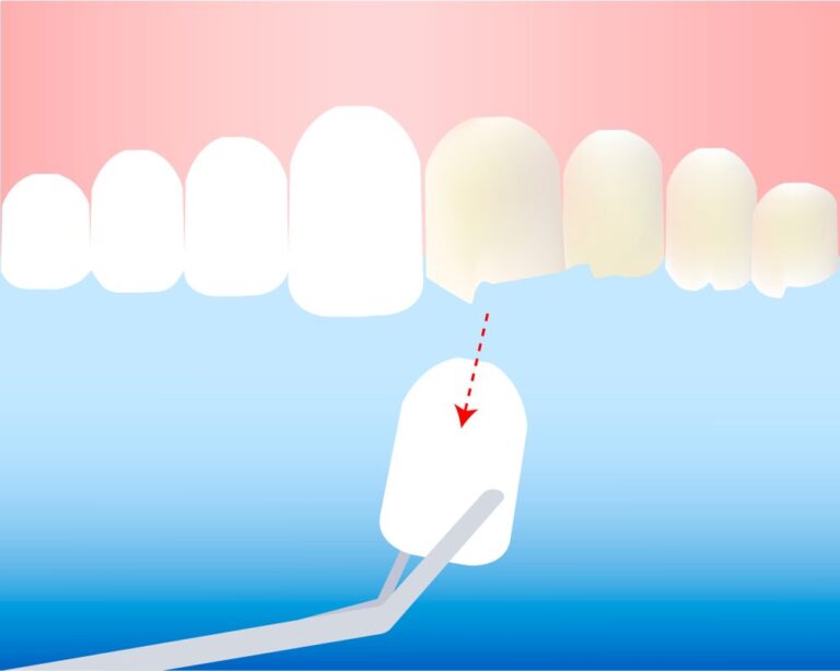 How much are veneers in Ky