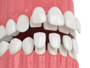 How much do veneers cost Australia