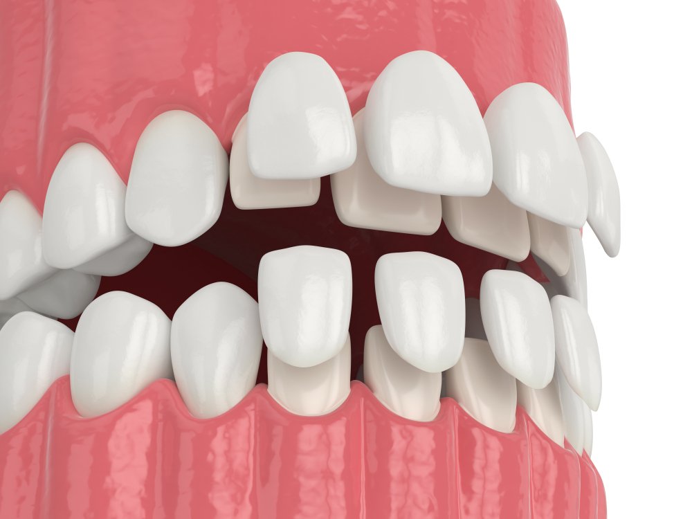 How much do veneers cost Australia