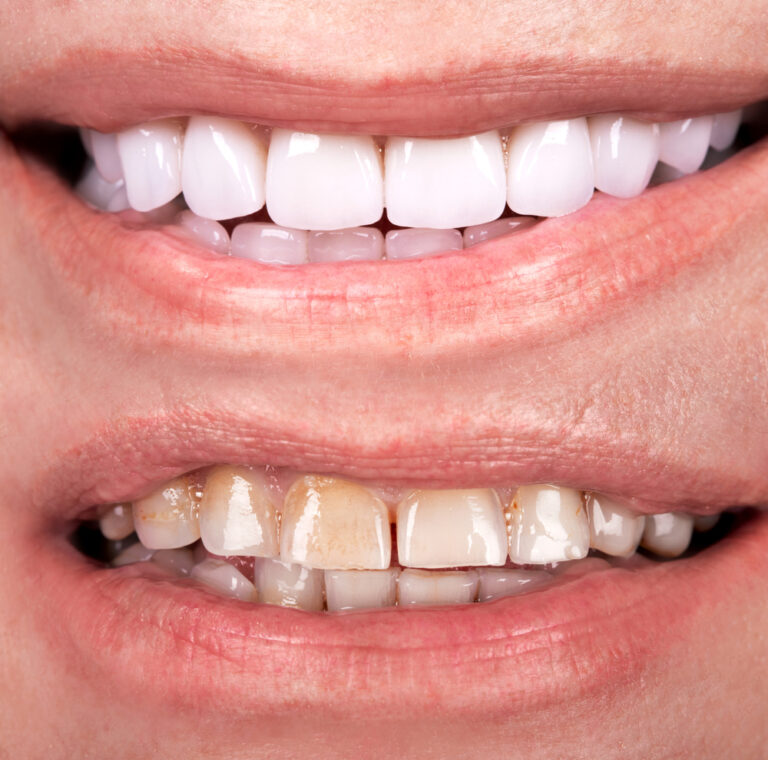 How much do veneers cost in Los Angeles