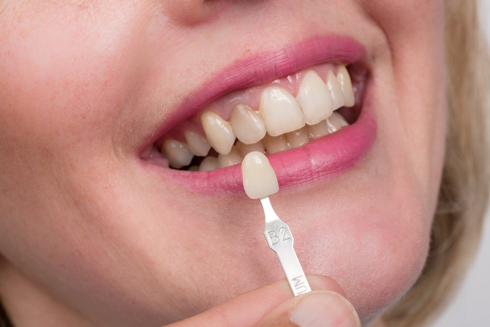 How much do veneers cost near Pennsylvania