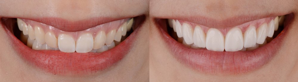 How to Choose the Right Full Mouth Veneer Provider