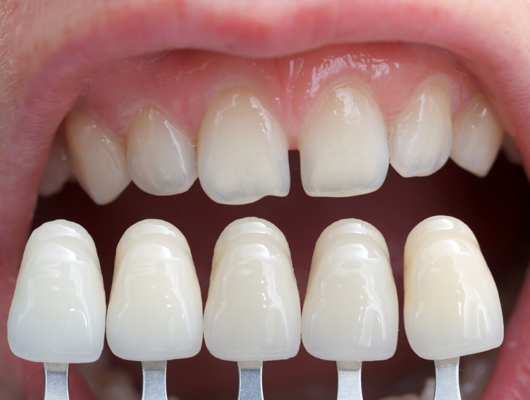 Why Choose Veneers