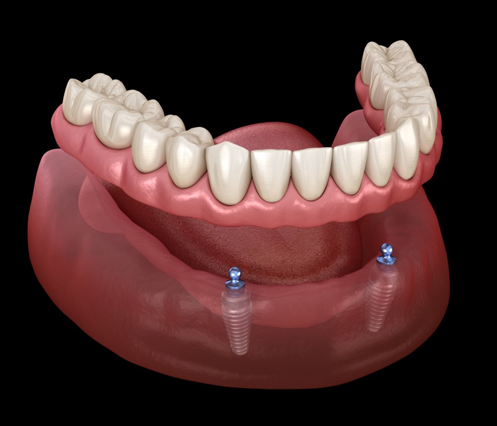 All on 4 Dental Implants Miami: Transform Your Smile