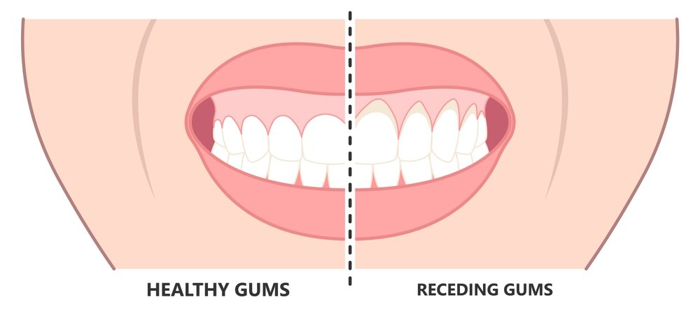 How much does a Gummy Smile Surgery cost in Miami