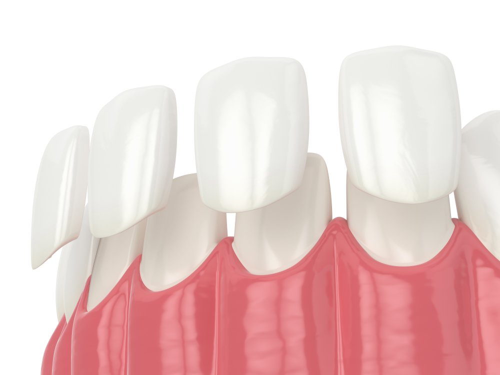 What are Composite Resin Veneers